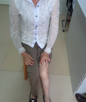 风湿2治疗后.jpg