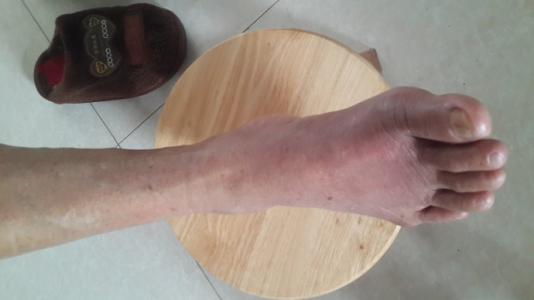 痛风患者会出现哪些特殊的症状