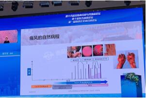 贵阳专业治疗痛风医院林孝义教授